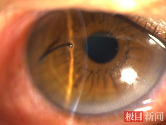 就因为没戴它！男子用角磨机给菜刀除锈眼球不慎被飞溅铁丝戳穿